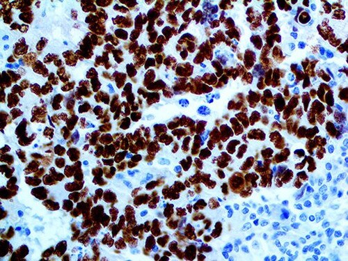 IHC of SALL4 on an FFPE 6E3 Testicular Cancer Metastasis to Liver Tissue